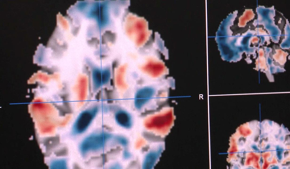 An example of brain activation from the Neurovault database. Red areas are activated by a particular task, blue areas are deactivated.